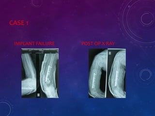 CASE 1
IMPLANT FAILURE POST OP X RAY
 