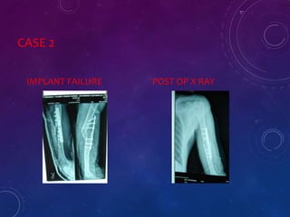CASE 2
IMPLANT FAILURE POST OP X RAY
 