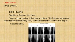 • TREATMENT:
POD1-1 WEEK:
BONE HEALING
Stability at fracture site: None.
Stage of bone healing: Inflammatory phase. The fracture hematoma is
colonized by inflammatory cells, and debridement of the fracture begins.
X-ray: No callus.
 