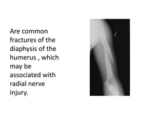 Are common
fractures of the
diaphysis of the
humerus , which
may be
associated with
radial nerve
injury.
 