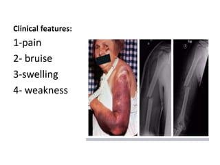 Clinical features:
1-pain
2- bruise
3-swelling
4- weakness
 