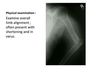 Physical examination :
Examine overall
limb alignment ;
often present with
shortening and in
varus.
 