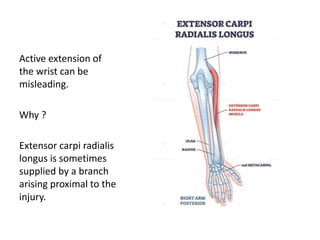 Active extension of
the wrist can be
misleading.
Why ?
Extensor carpi radialis
longus is sometimes
supplied by a branch
arising proximal to the
injury.
 