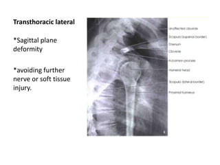 Transthoracic lateral
*Sagittal plane
deformity
*avoiding further
nerve or soft tissue
injury.
 