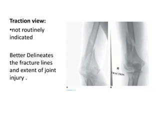 Traction view:
•not routinely
indicated
Better Delineates
the fracture lines
and extent of joint
injury .
 