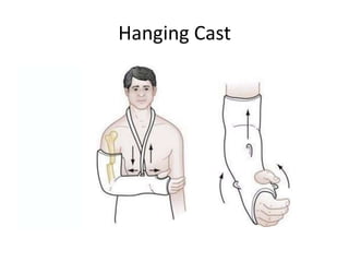 Hanging Cast
 