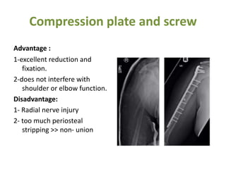 Compression plate and screw
Advantage :
1-excellent reduction and
fixation.
2-does not interfere with
shoulder or elbow function.
Disadvantage:
1- Radial nerve injury
2- too much periosteal
stripping >> non- union
 