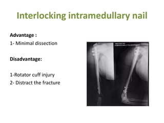 Interlocking intramedullary nail
Advantage :
1- Minimal dissection
Disadvantage:
1-Rotator cuff injury
2- Distract the fracture
 