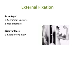 External Fixation
Advantage :
1- Segmental fracture
2- Open fracture
Disadvantage :
1- Radial nerve injury
 