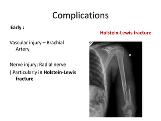 Complications
Early :
Vascular injury – Brachial
Artery
Nerve injury; Radial nerve
( Particularly in Holstein-Lewis
fracture
Holstein-Lewis fracture
 