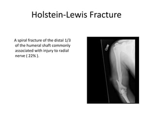 Holstein-Lewis Fracture
A spiral fracture of the distal 1/3
of the humeral shaft commonly
associated with injury to radial
nerve ( 22% ).
 