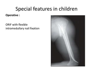 Special features in children
Operative :
ORIF with flexible
intramedullary nail fixation
 