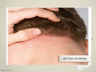 Humira | PPTX