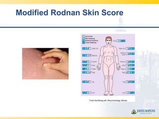 Rodnan Skin Biomarkers for Scleroderma | PPTX