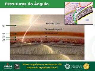 LS
TP
EE
CC
Vasos sanguíneos normalmente não
passam do esporão escleral !
Estruturas do Ângulo
 