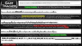 Gaze
Tracker Fixation Stability, No Gaze Errors of Any Significance Magnitude
Mostly Consistent Fixation, Except for a period of instability. Field showed a well-defined area of abnormality
that was Consistent with Follow-up Tests and the Result was considered to be of Good Reliability.
Frequent loss of tracking signal caused by Blinks or Other Interference by Lids or Lashes is indicated by the
many downward deflections in the trace, and may have been caused by Ptosis.
Unreliable Fixation. Numerous maximal gaze errors are combined with loss of tracking signal late in the test.
Occasional Gaze Track Rrrors. This represents Good Fixation Stability.
 