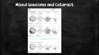 Mixed Glaucoma and Cataract
 