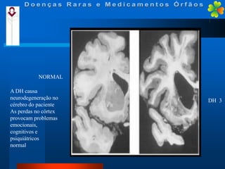 NORMAL
A DH causa
neurodegeneração no
cérebro do paciente
As perdas no córtex
provocam problemas
emocionais,
cognitivos e
psiquiátricos
normal

DH 3

 