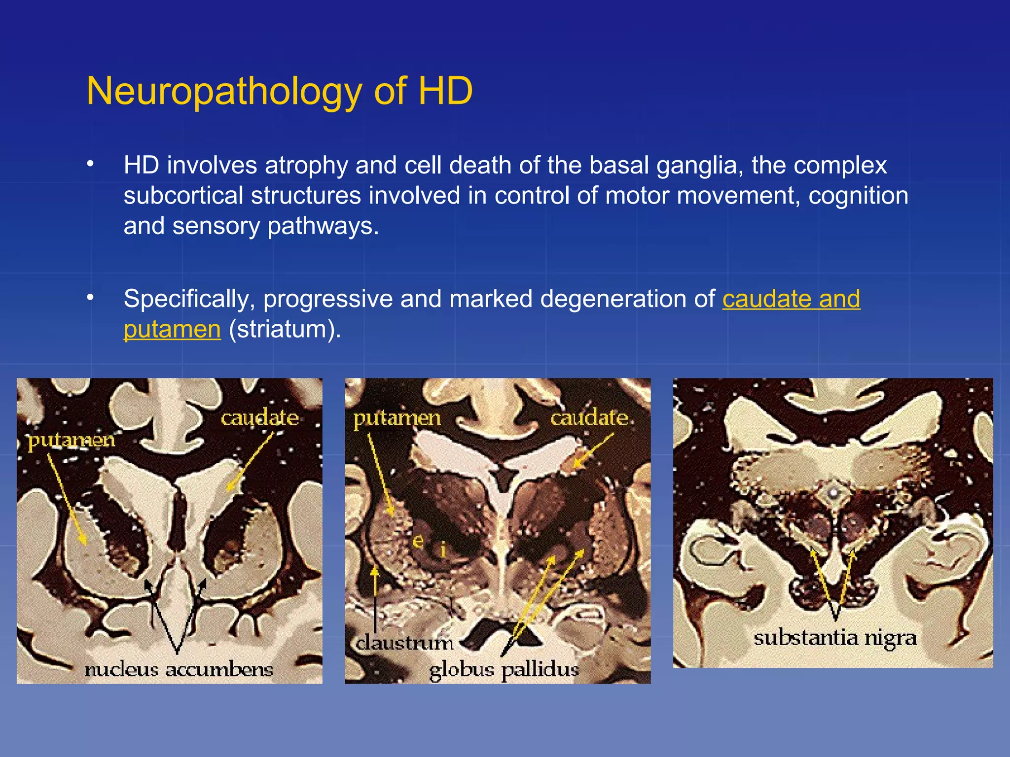Huntingtons disease | PPT