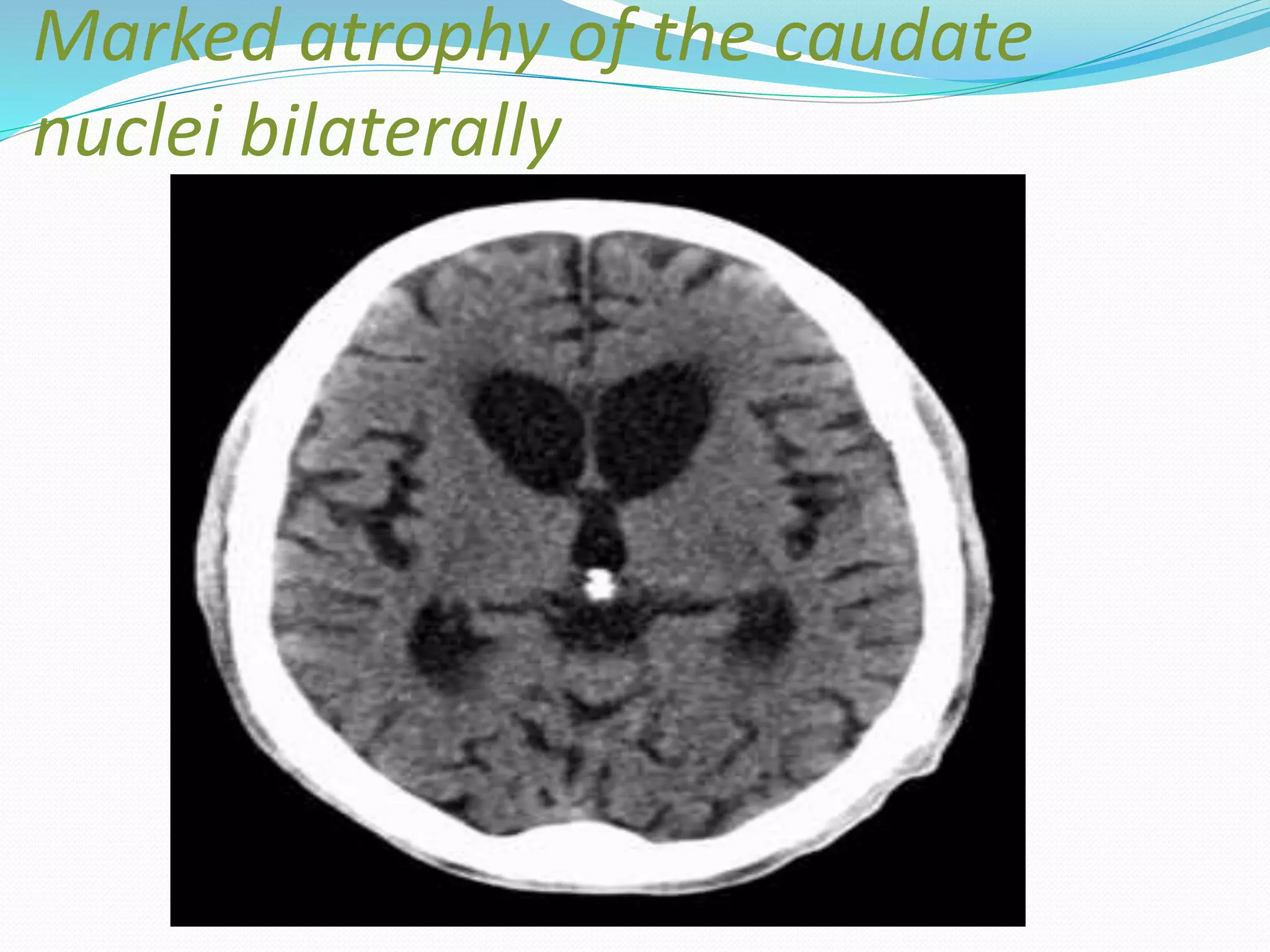 Marked atrophy of the caudate
nuclei bilaterally
 