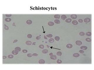 Schistocytes
 