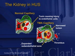 The Kidney in HUS Courtesy of P Tarr MD, Univ of Washington Normal Capillary TMA Capillary Thrombus Expanded  subendotheli...