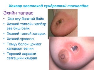Хөхөөр хооллоход хүндрэлтэй тохиолдол

Эхийн талаас
• Хөх сүү багатай байх
• Хөхний толгойн хэлбэр
зөв биш байх
• Хөхний толгой хагарах
• Хөхний үрэвсэл
• Томуу болон цочмог
халдварт өвчин
• Төрсний дараахи
сэтгэцийн хямрал

 