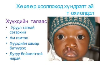 Хөхөөр хооллоход хүндрэлт эй
т охиолдол
Хүүхдийн талаас
• Уруул тагнай
сэтэрхий
• Ам гэмтэх
• Хүүхдийн хамар
битүүрэх
• Дутуу бойжилттой
нярай

 