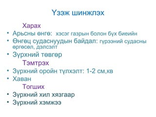 Үзэж шинжлэх
Харах
• Арьсны өнгө: хэсэг газрын болон бүх биеийн
• Өнгөц судаснуудын байдал: гүрээний судасны
өргөсөл, дэлсэлт

• Зүрхний төвгөр
Тэмтрэх

• Зүрхний оройн түлхэлт: 1-2 см,кв
• Хаван
Тогших
• Зүрхний хил хязгаар
• Зүрхний хэмжээ

 