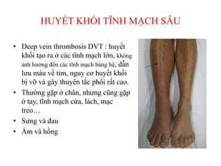 HUYẾT KHỐI TĨNH MẠCH SÂU
• Deep vein thrombosis DVT : huyết
khối tạo ra ở các tĩnh mạch lớn, không
ảnh hưởng đến các tĩnh mạch bàng hệ, dẫn
lưu máu về tim, nguy cơ huyết khối
bị vỡ và gây thuyên tắc phổi rất cao.
• Thường gặp ở chân, nhưng cũng gặp
ở tay, tĩnh mạch cửa, lách, mạc
treo…
• Sưng và đau
• Ấm và hồng
 