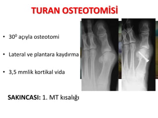 Hv distal osteotomi edit_hHALLUKS VALGUS - DİSTAL OSTEOTOMİLER