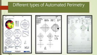 Different types of Automated Perimetry
 