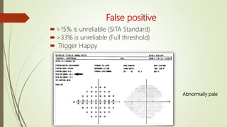 False positive
>15% is unreliable (SITA Standard)
>33% is unreliable (Full threshold)
 Trigger Happy
Abnormally pale
 