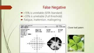 False Negative
>15% is unreliable (SITA Standard)
>33% is unreliable (Full threshold)
 Fatigue, inattention, malingering
Clover leaf patern
 