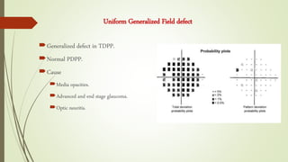 Generalized defect in TDPP.
Normal PDPP.
Cause
Media opacities.
Advanced and end stage glaucoma.
Optic neuritis.
Uniform Generalized Field defect
 