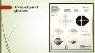 Advanced case of
glaucoma
 