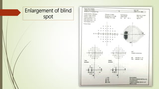 Enlargement of blind
spot
 