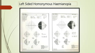 Left Sided Homonymous Haemianopia
 