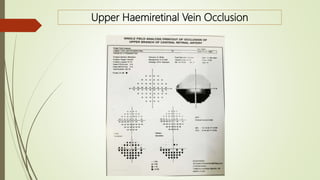 Upper Haemiretinal Vein Occlusion
 