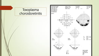 Toxoplasma
choroidoretinitis
 