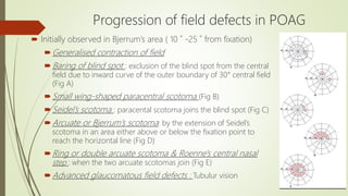 Progression of field defects in POAG
 Initially observed in Bjerrum’s area ( 10 ˚ -25 ˚ from fixation)
Generalised contraction of field
Baring of blind spot : exclusion of the blind spot from the central
field due to inward curve of the outer boundary of 30° central field
(Fig A)
Small wing-shaped paracentral scotoma (Fig B)
Seidel’s scotoma : paracental scotoma joins the blind spot (Fig C)
Arcuate or Bjerrum’s scotoma: by the extension of Seidel’s
scotoma in an area either above or below the fixation point to
reach the horizontal line (Fig D)
Ring or double arcuate scotoma & Roenne's central nasal
step : when the two arcuate scotomas join (Fig E)
Advanced glaucomatous field defects : Tubulur vision
 