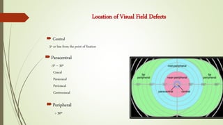 Location of Visual Field Defects
Peripheral
> 30º
 Central
5º or less from the point of fixation
Paracentral
>5º – 30º
Ceacal
Paraceacal
Periceacal
Centroceacal
 