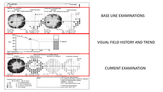 BASE LINE EXAMINATIONS
VISUAL FIELD HISTORY AND TREND
CURRENT EXAMINATION
 
