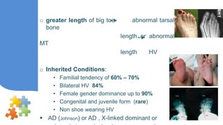 Outcome of Mitchell's procedure in the treatment of hallux valgus | PPTX