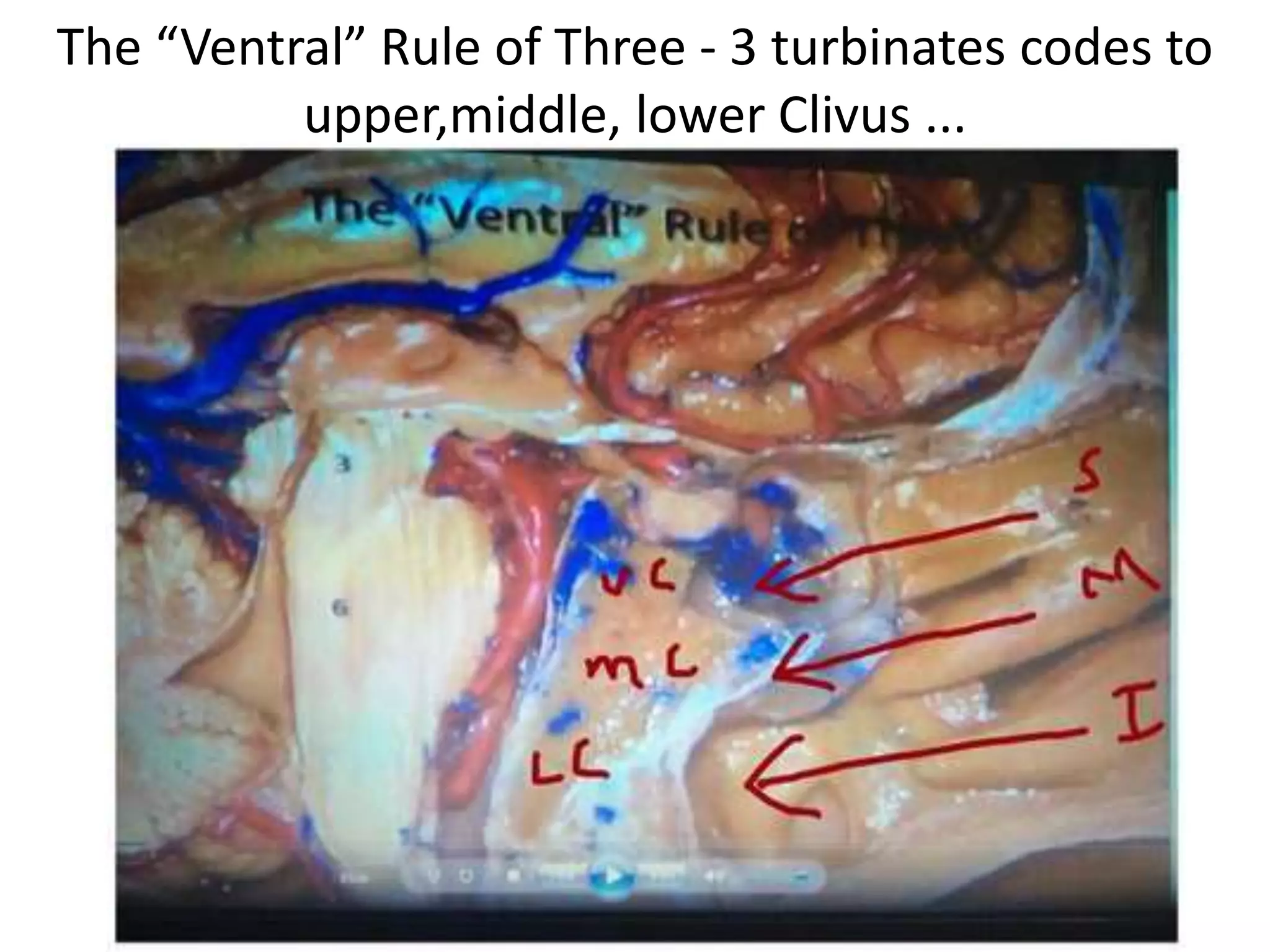 Clivus
1. Upper Clivus
2. Mid Clivus
3. Lower Clivus
 