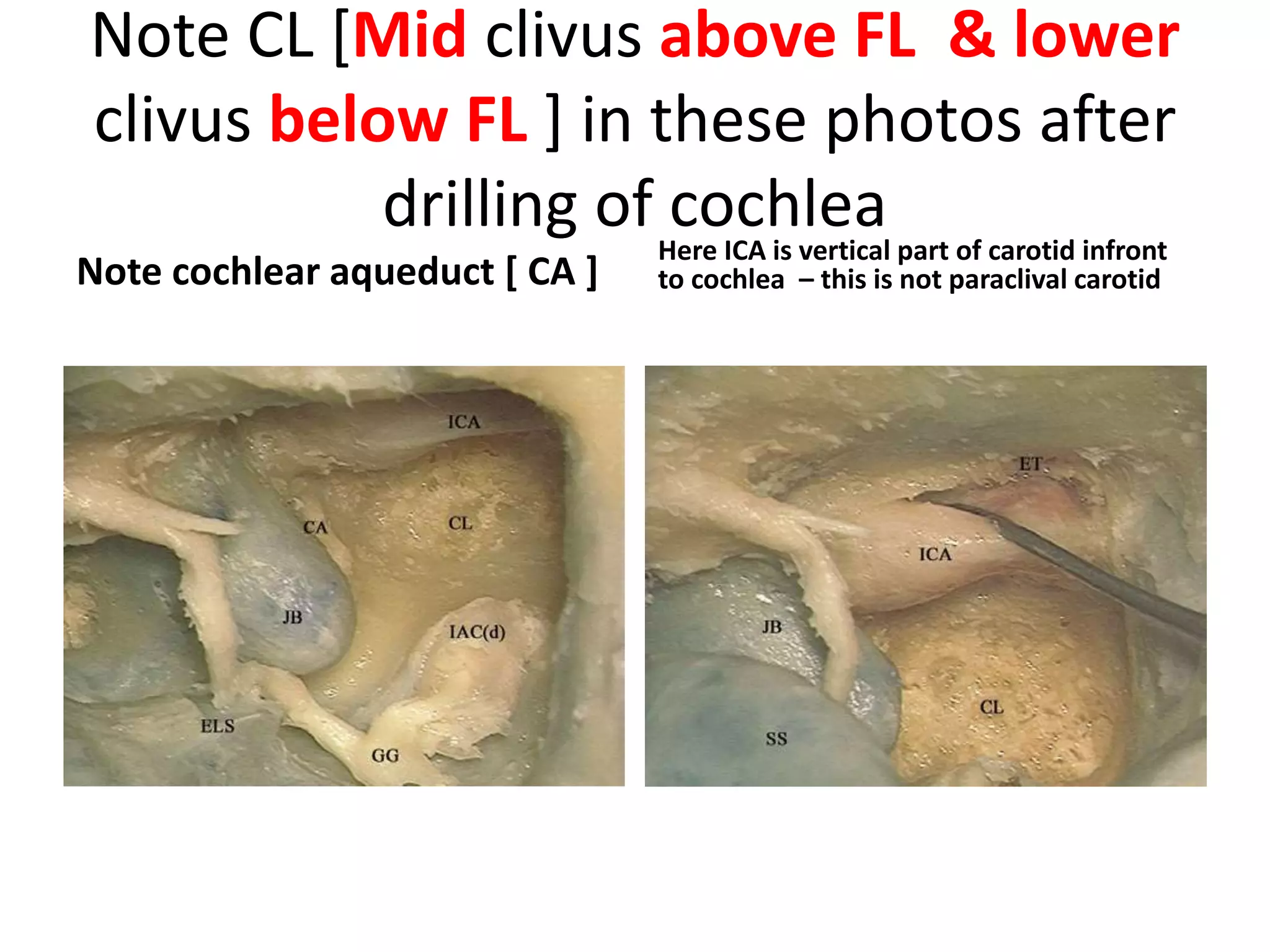 PICA can be seen running between spinal and cranial portions of the accessory
nerves (CN XI – S, CN XI – C).
Endoscopic lateral skull
base
Endoscopic anterior
skull base
Lateral skull base – far
lateral approach
 