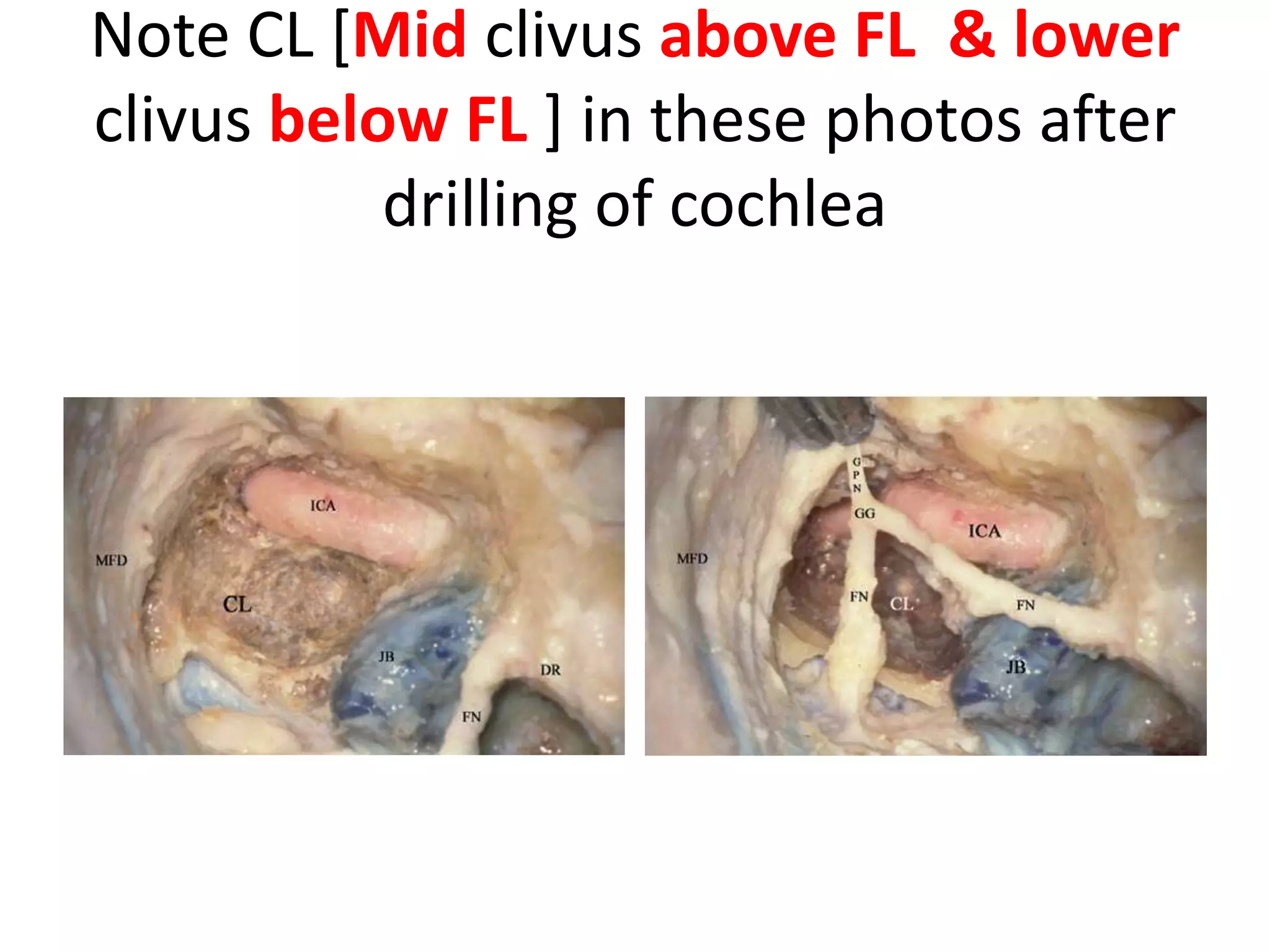 PICA passes between two bundles of 12th nerve &
between two roots of 11th nerve
Cadaveric dissection image demonstrating the posterior inferior cerebellar artery (PICA) running
between the vagus (CN X) and the cranial accessory nerve rootlets (CN XI-C) at the position where
the nerves exit the brainstem. CN VII, facial nerve; CN VIII, vestibulocochlear nerve; NI, nervus
intermedius; CN IX, glossopharyngeal nerve; CN XI-S, spinal accessory nerve
The tip of the endoscope lies between the
acousticofacial nerve bundle and the anterior
inferior cerebellar artery. The posterior inferior
cerebellar artery arises from the vertebral artery,
runs between the root fibers of the hypoglossal
nerve, and forms a loop below the roots of the
lower cranial nerves, before coursing in a posterior
direction.
 