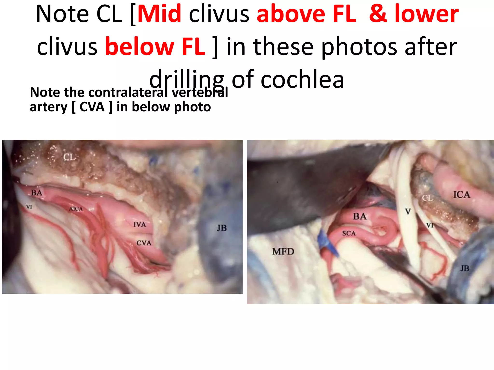 Transcochlear approach leads to Mid clivus above foramen
lacerum [ FL ] & lower clivus below foramen lacerum [ FL ]
AAAM anterior atlanto-axial membrane, AAOM anterior atlanto-occipital membrane, AIM anterior intertrasversarius muscle, Cl clivus, C1
atlas, C1TP transverse process of C1, C2 axis, ET eustachian tube, JF jugular foramen, JT jugular tubercle, HC hypoglossal canal, ICAc cavernous
portion of the internal carotid artery, LCapM longus capitis muscle, LColM longus colli muscle, PG pituitary gland, RCAM rectus capitis
anterior muscle, RCLM rectus capitis lateralis muscle, blue-sky arrow apical ligament, green arrow external ori fi ce of the hypoglossal canal,
black arrow lateral atlanto-occipital ligament, black asterisk foramen lacerum
 