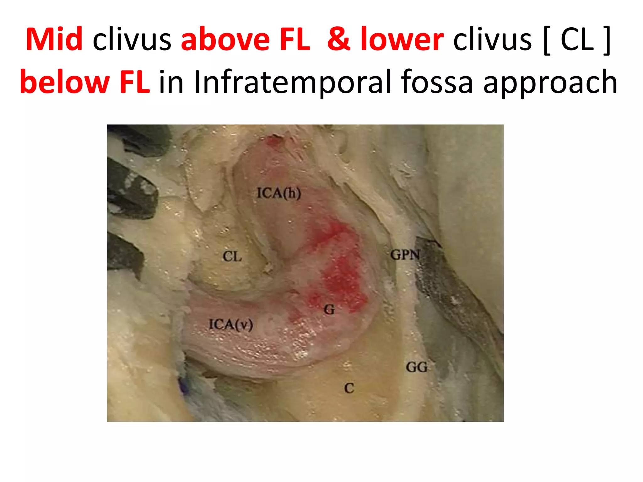 Note CL [ Mid clivus above FL & lower clivus below FL ] in these
photos after drilling of cochlea
 