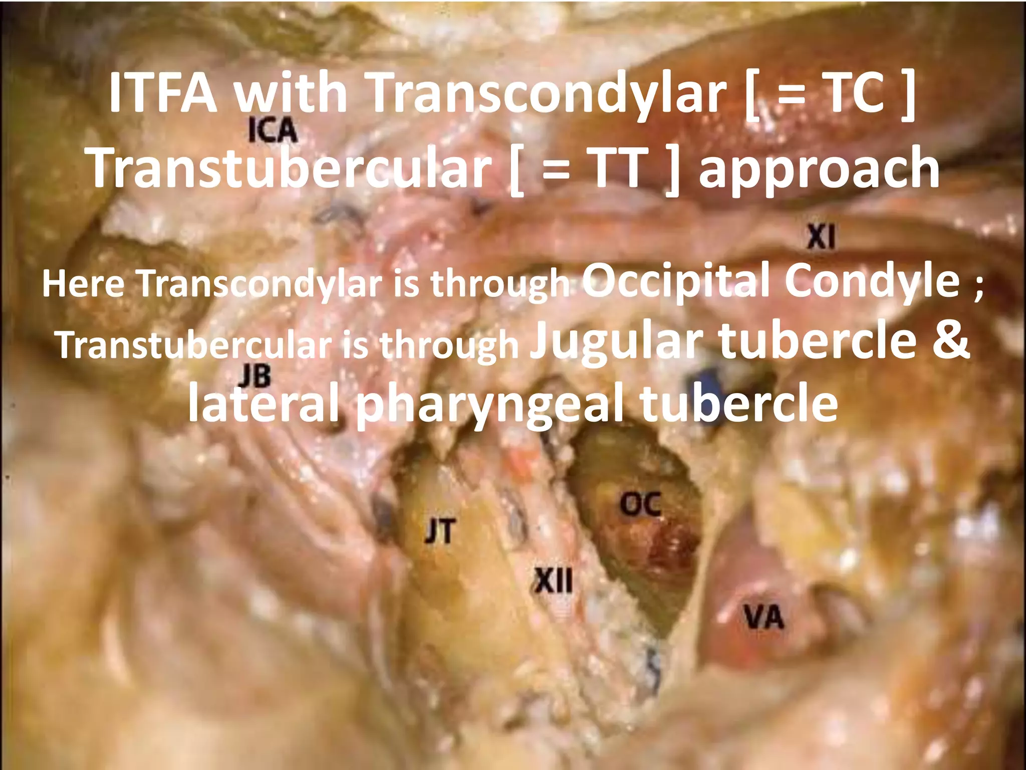 Note CL [Mid clivus above FL & lower clivus below FL ] in these
photos after drilling of cochlea
The clivus bone (CL) can be seen
medial to the internal carotid
artery (ICA). JB Jugular bulb
In the lower part of the approach, the
glossopharyngeal nerve
(IX) can be seen. V Trigeminal nerve, VIII Cochlear
nerve, AICA Anterior
inferior cerebellar artery, CL Clivus bone, DV
Dandy’s vein, FN Facial
nerve, FN(m) Mastoid segment of the facial nerve,
FN(t) Tympanic segment
of the facial nerve, GG Geniculate ganglion, ICA
Internal carotid
artery, JB Jugular bulb, MFD Middle fossa dura, SCA
Superior cerebellar
artery, SS Sigmoid sinus
 